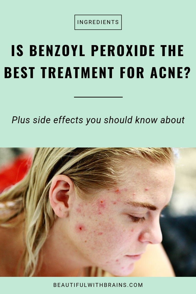 is benzoyl peroxide the best treatment for acne