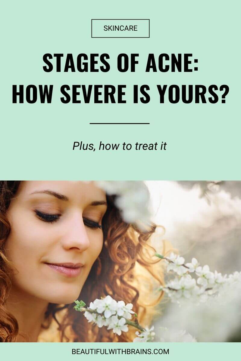 stages of acne and how to treat them